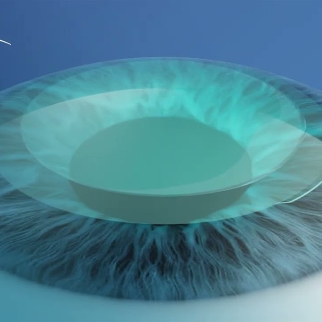 SmartSight