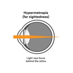 Farsightedness (hyperopia)